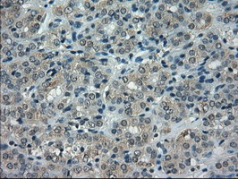 CRYAB / Alpha B Crystallin Antibody - IHC of paraffin-embedded Carcinoma of thyroid tissue using anti-CRYAB mouse monoclonal antibody. (Dilution 1:50).