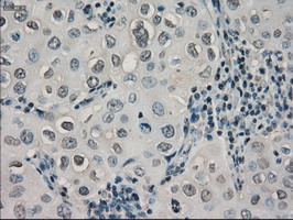 CRYAB / Alpha B Crystallin Antibody - IHC of paraffin-embedded Adenocarcinoma of breast tissue using anti-CRYAB mouse monoclonal antibody. (Dilution 1:50).