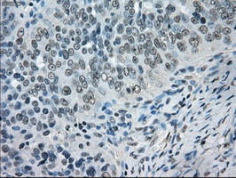 CRYAB / Alpha B Crystallin Antibody - IHC of paraffin-embedded Adenocarcinoma of ovary tissue using anti-CRYAB mouse monoclonal antibody. (Dilution 1:50).