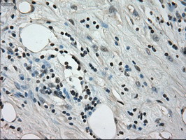 CRYAB / Alpha B Crystallin Antibody - IHC of paraffin-embedded Carcinoma of pancreas tissue using anti-CRYAB mouse monoclonal antibody. (Dilution 1:50).