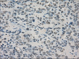 CRYAB / Alpha B Crystallin Antibody - IHC of paraffin-embedded Carcinoma of bladder tissue using anti-CRYAB mouse monoclonal antibody. (Dilution 1:50).