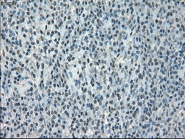 CRYAB / Alpha B Crystallin Antibody - IHC of paraffin-embedded lymphoma tissue using anti-CRYAB mouse monoclonal antibody. (Dilution 1:50).