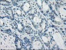 CRYAB / Alpha B Crystallin Antibody - IHC of paraffin-embedded Adenocarcinoma of colon tissue using anti-CRYAB mouse monoclonal antibody. (Dilution 1:50).