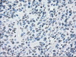 CRYAB / Alpha B Crystallin Antibody - IHC of paraffin-embedded Carcinoma of bladder tissue using anti-CRYAB mouse monoclonal antibody. (Dilution 1:50).