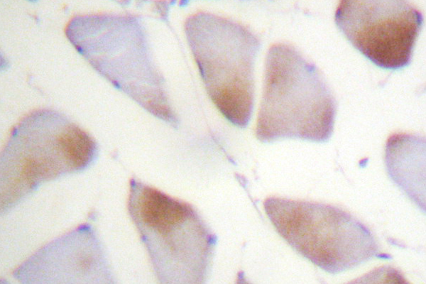 CRYAB / Alpha B Crystallin Antibody - IHC of Crystallin-B (L55) pAb in paraffin-embedded human breast carcinoma tissue.