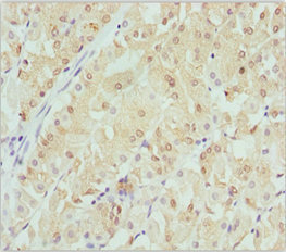 CRYGS Antibody - Immunohistochemistry of paraffin-embedded human gastric cancer at dilution 1:100