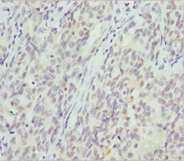 CRYGS Antibody - Immunohistochemistry of paraffin-embedded human lung cancer at dilution 1:100