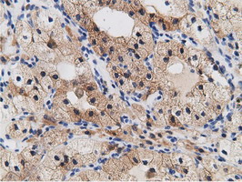 CRYM Antibody - IHC of paraffin-embedded Carcinoma of Human kidney tissue using anti-CRYM mouse monoclonal antibody.