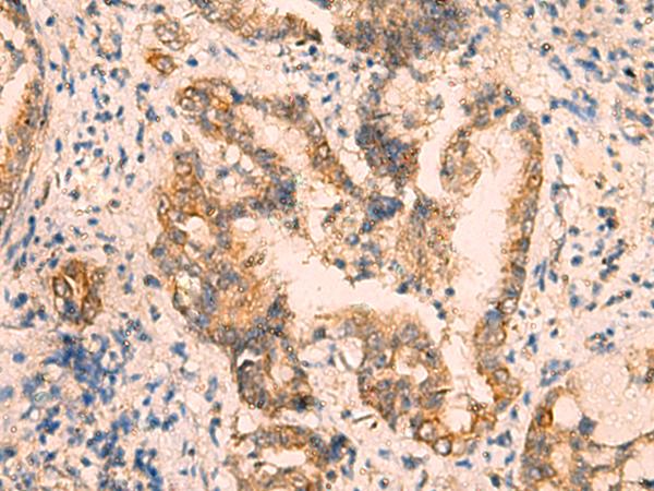 CRYM Antibody - Immunohistochemistry of paraffin-embedded Human cervical cancer tissue  using CRYM Polyclonal Antibody at dilution of 1:65(×200)
