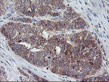 CRYZL1 Antibody - IHC of paraffin-embedded Adenocarcinoma of Human ovary tissue using anti-CRYZL1 mouse monoclonal antibody.