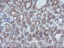 CRYZL1 Antibody - IHC of paraffin-embedded Carcinoma of Human thyroid tissue using anti-CRYZL1 mouse monoclonal antibody.