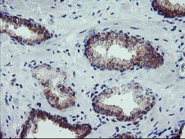 CRYZL1 Antibody - IHC of paraffin-embedded Carcinoma of Human prostate tissue using anti-CRYZL1 mouse monoclonal antibody.