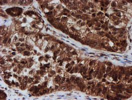 CRYZL1 Antibody - IHC of paraffin-embedded Adenocarcinoma of Human ovary tissue using anti-CRYZL1 mouse monoclonal antibody. (Heat-induced epitope retrieval by 10mM citric buffer, pH6.0, 100C for 10min).