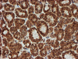 CRYZL1 Antibody - IHC of paraffin-embedded Carcinoma of Human thyroid tissue using anti-CRYZL1 mouse monoclonal antibody. (Heat-induced epitope retrieval by 10mM citric buffer, pH6.0, 100C for 10min).