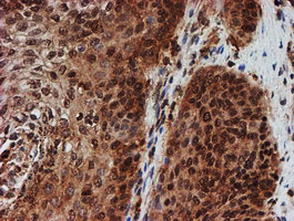 CRYZL1 Antibody - IHC of paraffin-embedded Carcinoma of Human bladder tissue using anti-CRYZL1 mouse monoclonal antibody. (Heat-induced epitope retrieval by 10mM citric buffer, pH6.0, 100C for 10min).