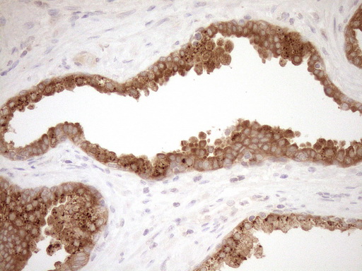 CSA / ERCC8 Antibody - Immunohistochemical staining of paraffin-embedded Carcinoma of Human prostate tissue using anti-ERCC8 mouse monoclonal antibody. (Heat-induced epitope retrieval by 1mM EDTA in 10mM Tris buffer. (pH8.5) at 120°C for 3 min. (1:150)