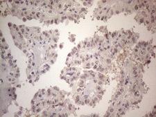 CSA / ERCC8 Antibody - Immunohistochemical staining of paraffin-embedded Carcinoma of Human thyroid tissue using anti-ERCC8 mouse monoclonal antibody. (Heat-induced epitope retrieval by 1mM EDTA in 10mM Tris buffer. (pH8.5) at 120°C for 3 min. (1:150)