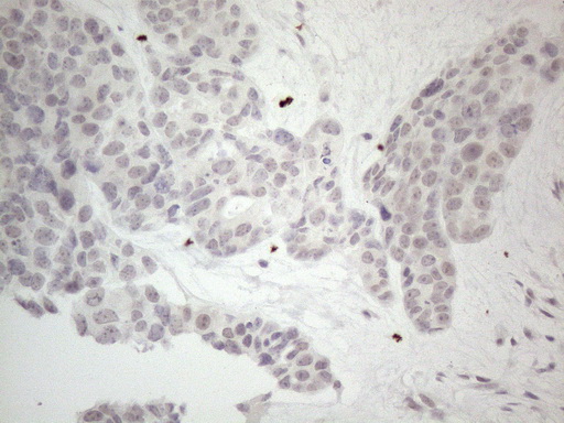 CSA / ERCC8 Antibody - Immunohistochemical staining of paraffin-embedded Adenocarcinoma of Human endometrium tissue using anti-ERCC8 mouse monoclonal antibody. (Heat-induced epitope retrieval by 1mM EDTA in 10mM Tris buffer. (pH8.5) at 120°C for 3 min. (1:150)