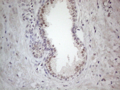 CSA / ERCC8 Antibody - Immunohistochemical staining of paraffin-embedded Carcinoma of Human prostate tissue using anti-ERCC8 mouse monoclonal antibody. (Heat-induced epitope retrieval by 1mM EDTA in 10mM Tris buffer. (pH8.5) at 120°C for 3 min. (1:150)