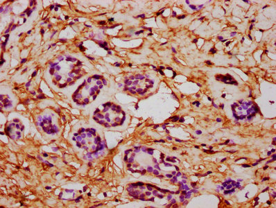 CSAD / CSD Antibody - Immunohistochemistry Dilution at 1:600 and staining in paraffin-embedded human breast cancer performed on a Leica BondTM system. After dewaxing and hydration, antigen retrieval was mediated by high pressure in a citrate buffer (pH 6.0). Section was blocked with 10% normal Goat serum 30min at RT. Then primary antibody (1% BSA) was incubated at 4°C overnight. The primary is detected by a biotinylated Secondary antibody and visualized using an HRP conjugated SP system.