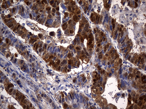 CSE1L Antibody - Immunohistochemical staining of paraffin-embedded Human Gastric Carcinoma using anti-CSE1L mouse monoclonal antibody. (Heat-induced epitope retrieval by 1mM EDTA in 10mM Tris buffer. (pH8.5) at 120°C for 3 min. (1:2000)