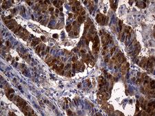 CSE1L Antibody - Immunohistochemical staining of paraffin-embedded Human Gastric Carcinoma using anti-CSE1L mouse monoclonal antibody. (Heat-induced epitope retrieval by 1mM EDTA in 10mM Tris buffer. (pH8.5) at 120°C for 3 min. (1:2000)