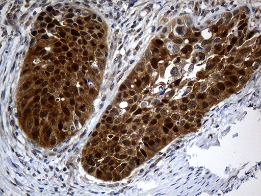 CSE1L Antibody - Immunohistochemical staining of paraffin-embedded Carcinoma of Human kidney tissue using anti-CSE1L mouse monoclonal antibody. (Heat-induced epitope retrieval by 1mM EDTA in 10mM Tris buffer. (pH8.5) at 120°C for 3 min. (1:2000)