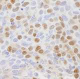 CSE1L Antibody - Detection of Human CSE1 by Immunohistochemistry. Sample: FFPE section of human breast tumor. Antibody: Affinity purified rabbit anti-CSE used at a dilution of 1:500.