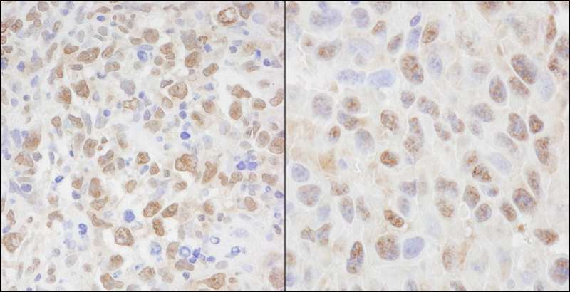 CSE1L Antibody - Detection of Human and Mouse CSE1 by Immunohistochemistry. Sample: FFPE section of human metastatic lymph node (left) and mouse squamous cell carcinoma (right). Antibody: Affinity purified rabbit anti-CSE1 used at a dilution of 1:5000 (0.2 ug/ml) and 1:1000 (1 ug/ml). Detection: DAB.