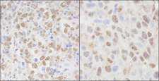 CSE1L Antibody - Detection of Human and Mouse CSE1 by Immunohistochemistry. Sample: FFPE section of human metastatic lymph node (left) and mouse squamous cell carcinoma (right). Antibody: Affinity purified rabbit anti-CSE1 used at a dilution of 1:5000 (0.2 ug/ml) and 1:1000 (1 ug/ml). Detection: DAB.