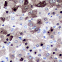 CSE1L Antibody - Immunohistochemical analysis of XPO2 staining in human liver cancer formalin fixed paraffin embedded tissue section. The section was pre-treated using heat mediated antigen retrieval with sodium citrate buffer (pH 6.0). The section was then incubated with the antibody at room temperature and detected using an HRP conjugated compact polymer system. DAB was used as the chromogen. The section was then counterstained with hematoxylin and mounted with DPX.