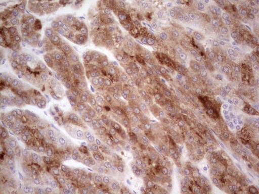 CSF1 / MCSF Antibody - Immunohistochemical staining of paraffin-embedded Carcinoma of Human liver tissue using anti-CSF1 mouse monoclonal antibody.  heat-induced epitope retrieval by 1 mM EDTA in 10mM Tris, pH8.5, 120C for 3min)
