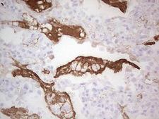 CSF1 / MCSF Antibody - Immunohistochemical staining of paraffin-embedded Carcinoma of Human lung tissue using anti-CSF1 mouse monoclonal antibody. (Heat-induced epitope retrieval by 1 mM EDTA in 10mM Tris, pH8.5, 120C for 3min,