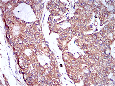 CSF1R / CD115 / FMS Antibody - IHC of paraffin-embedded prostate cancer tissues using CSF1R mouse monoclonal antibody with DAB staining.