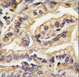 CSF1R / CD115 / FMS Antibody - Formalin-fixed and paraffin-embedded human lung carcinoma tissue reacted with CSF1R Antibody , which was peroxidase-conjugated to the secondary antibody, followed by DAB staining. This data demonstrates the use of this antibody for immunohistochemistry; clinical relevance has not been evaluated.