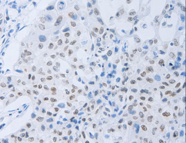 CSF1R / CD115 / FMS Antibody - Immunohistochemistry of paraffin-embedded Human lung cancer using CSF1R Polyclonal Antibody at dilution of 1:45.