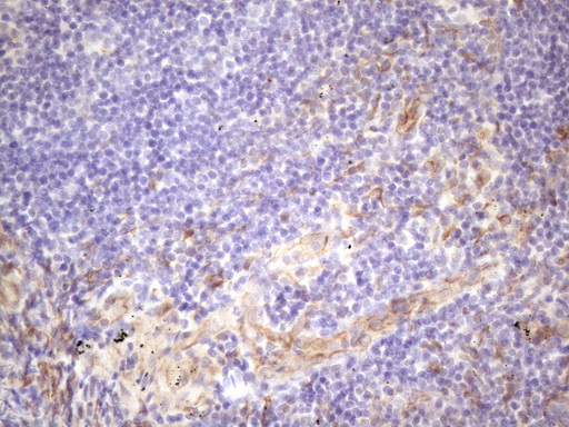CSF2 / GM-CSF Antibody - Immunohistochemical staining of paraffin-embedded Carcinoma of Human lung tissue using anti-CSF2 mouse monoclonal antibody. (Heat-induced epitope retrieval by 1 mM EDTA in 10mM Tris, pH8.5, 120C for 3min. (1:150)