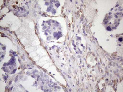 CSF2 / GM-CSF Antibody - Immunohistochemical staining of paraffin-embedded Adenocarcinoma of Human ovary tissue using anti-CSF2 mouse monoclonal antibody. (Heat-induced epitope retrieval by 1 mM EDTA in 10mM Tris, pH8.5, 120C for 3min. (1:150)