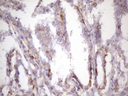 CSF2 / GM-CSF Antibody - Immunohistochemical staining of paraffin-embedded Carcinoma of Human thyroid tissue using anti-CSF2 mouse monoclonal antibody. (Heat-induced epitope retrieval by 1 mM EDTA in 10mM Tris, pH8.5, 120C for 3min. (1:150)