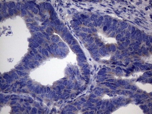 CSF2 / GM-CSF Antibody - Immunohistochemical staining of paraffin-embedded Adenocarcinoma of Human colon tissue using anti-CSF2 mouse monoclonal antibody. (Heat-induced epitope retrieval by 1mM EDTA in 10mM Tris buffer. (pH8.5) at 120°C for 3 min. (1:150)