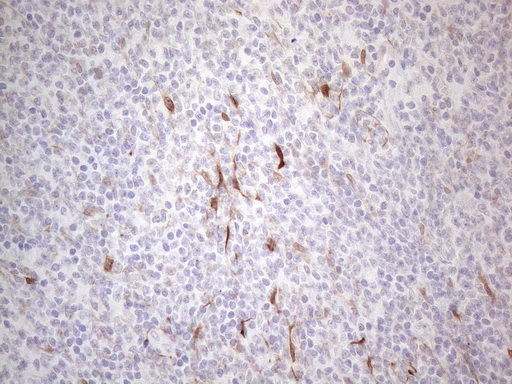 CSF2 / GM-CSF Antibody - Immunohistochemical staining of paraffin-embedded Human lymphoma tissue using anti-CSF2 mouse monoclonal antibody. (Heat-induced epitope retrieval by 1mM EDTA in 10mM Tris buffer. (pH8.5) at 120°C for 3 min. (1:150)