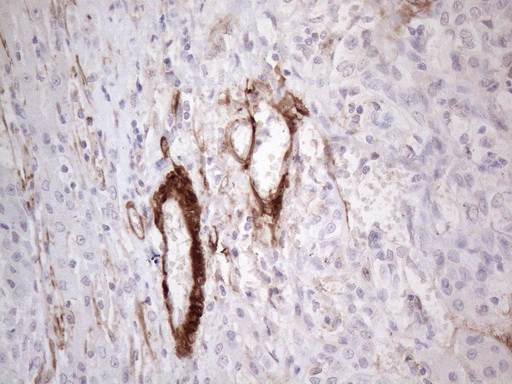 CSF2 / GM-CSF Antibody - Immunohistochemical staining of paraffin-embedded Carcinoma of Human liver tissue using anti-CSF2 mouse monoclonal antibody. (Heat-induced epitope retrieval by 1mM EDTA in 10mM Tris buffer. (pH8.5) at 120°C for 3 min. (1:150)
