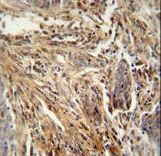 CSF2 / GM-CSF Antibody - CSF2 antibody immunohistochemistry of formalin-fixed and paraffin-embedded human lung carcinoma followed by peroxidase-conjugated secondary antibody and DAB staining.