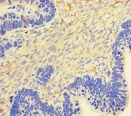 CSF2 / GM-CSF Antibody - Immunohistochemistry of paraffin-embedded human ovarian cancer using CSF2 Antibody at dilution of 1:100