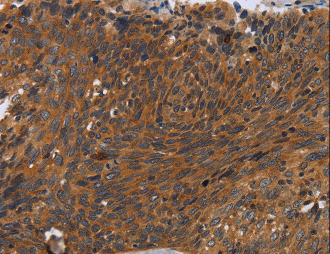 CSF2RA / CD116 Antibody - Immunohistochemistry of paraffin-embedded Human cervical cancer using CSF2RA Polyclonal Antibody at dilution of 1:35.