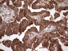 CSF2RB / CD131 Antibody - Immunohistochemical staining of paraffin-embedded Adenocarcinoma of Human ovary tissue using anti-CSF2RB mouse monoclonal antibody. (Heat-induced epitope retrieval by 1mM EDTA in 10mM Tris buffer. (pH8.5) at 120 oC for 3 min. (1:150)