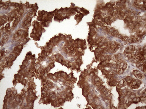 CSF2RB / CD131 Antibody - Immunohistochemical staining of paraffin-embedded Carcinoma of Human thyroid tissue using anti-CSF2RB mouse monoclonal antibody. (Heat-induced epitope retrieval by 1mM EDTA in 10mM Tris buffer. (pH8.5) at 120 oC for 3 min. (1:150)
