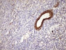 CSF2RB / CD131 Antibody - Immunohistochemical staining of paraffin-embedded Carcinoma of Human pancreas tissue using anti-CSF2RB mouse monoclonal antibody. (Heat-induced epitope retrieval by Tris-EDTA, pH8.0)(1:150)