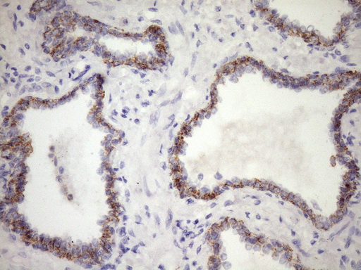 CSF2RB / CD131 Antibody - Immunohistochemical staining of paraffin-embedded Carcinoma of Human prostate tissue using anti-CSF2RB mouse monoclonal antibody. (Heat-induced epitope retrieval by Tris-EDTA, pH8.0)(1:150)