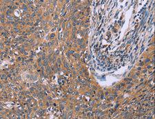 CSF2RB / CD131 Antibody - Immunohistochemistry of paraffin-embedded Human ovarian cancer using CSF2RB Polyclonal Antibody at dilution of 1:40.